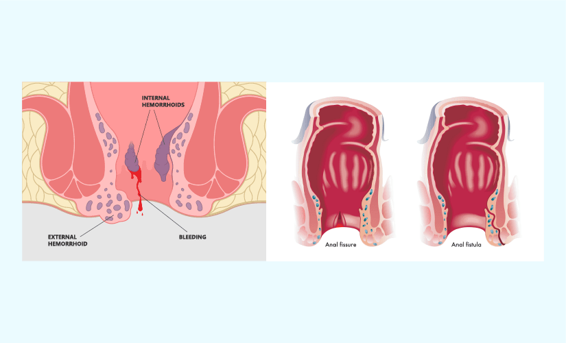 Difference Between Piles And Fistula